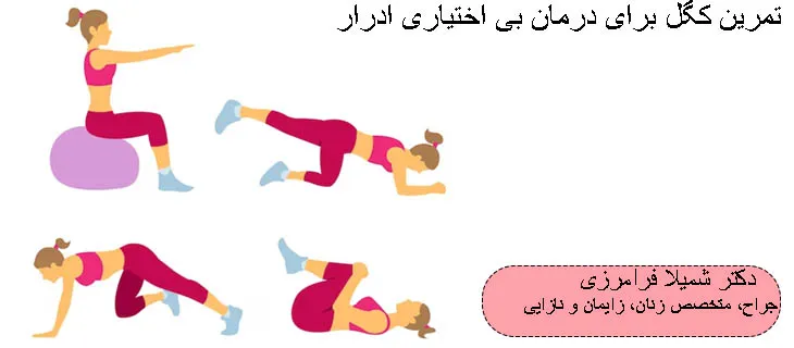 تمرین کگل برای درمان بی اختیاری ادرار