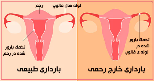 علائم و نشانه هاى باردارى خارج از رحم چیست؟