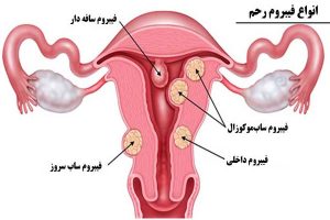 انواع فیبروم رحم