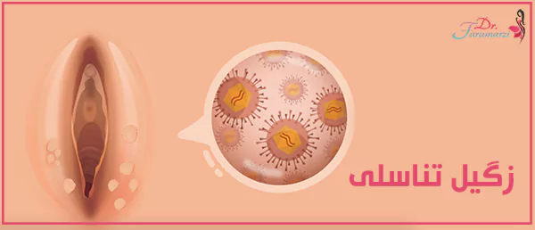 زگیل تناسلی چیست؟