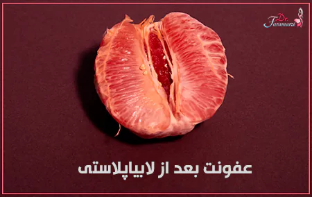 دلایل ایجاد عفونت بعد از لابیاپلاستی چیست؟