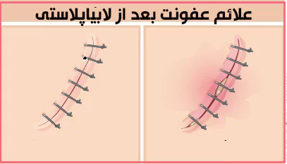 علائم عفونت بعد از لابیاپلاستی چیست؟