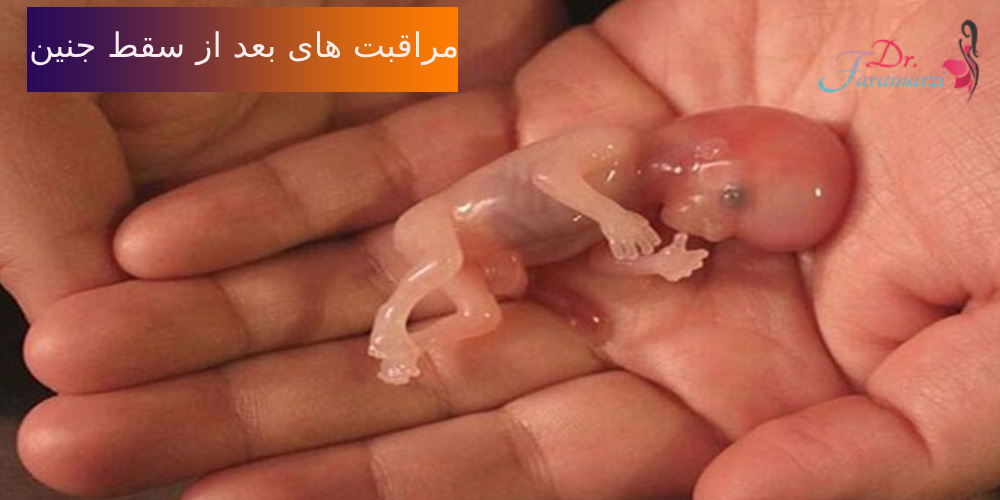 مراقبت های بعد از سقط جنین