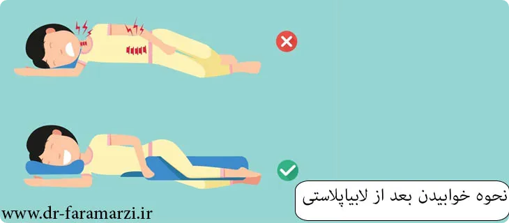 نحوه خوابیدن بعد از جراحی لابیاپلاستی
