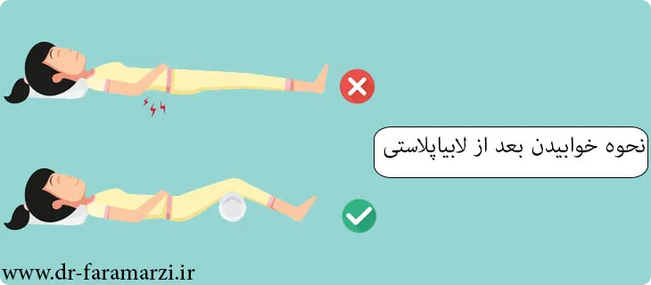 نحوه خوابیدن صحیح بعد از لابیاپلاستی
